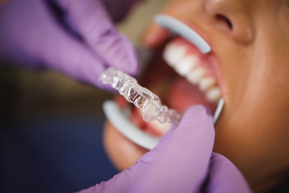 invisalign braces being fitted